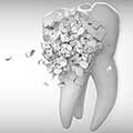 Zähneknirschen: Stress ist oft die Ursache